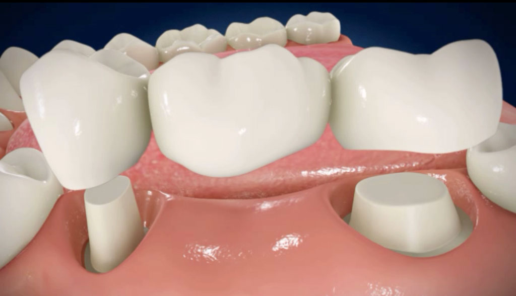 Dental Bridges