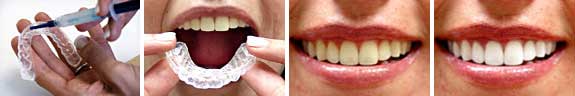 Teeth Whitening